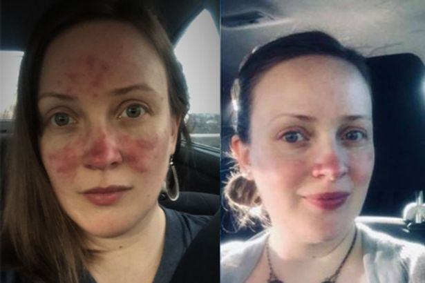 Ex model 'cried in husband's arms' about rosacea until one cream 'changed my life'